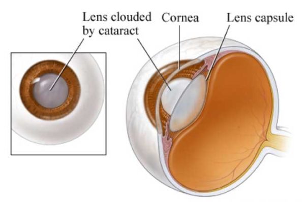 Cataract surgery in Virgin Islands