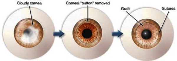 corneal disease treatment in Virgin Islands