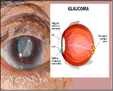 Glaucoma2-cpr - Plessenophthalmology.com