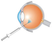 Retinal Services and Surgery - plessenophthalmology.com