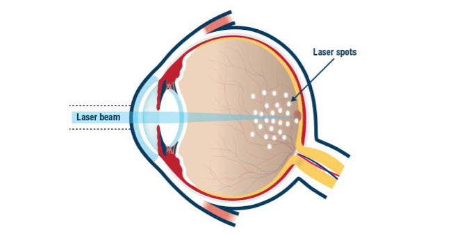 hole in retina surgery