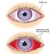 Uveitis - Plessenophthalmology.com