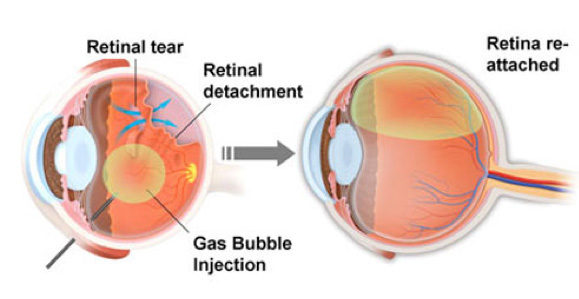 gas bubble detached retina